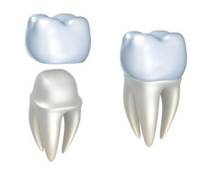 Porcelain Dental Crown