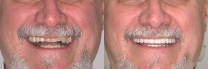 Restoring chipped and worn out teeth with Dental Crowns