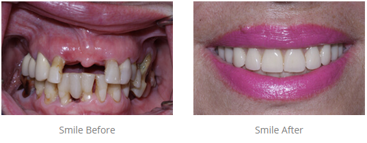 Before and after teeth in a day procedure
