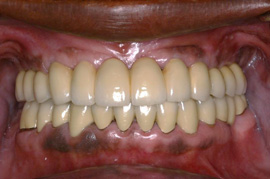 Removable Complete Denture on the Top (before)