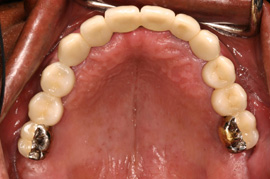 Edentulous Upper Arch with Implants in Place (before)