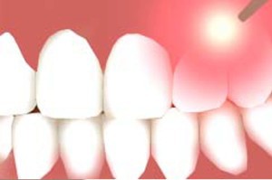 Laser Dentistry in NYC