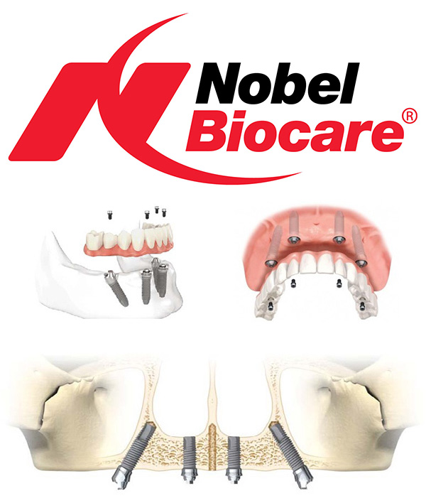 Why we use Nobel Biocare dental implants? - MSR Dentistry in Chennai