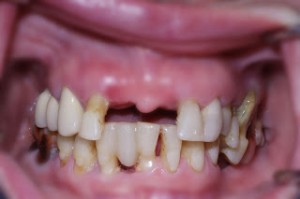 Teeth in a Day Dental Implants