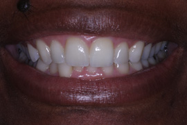 How much do porcelain veneers cost?