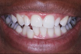 How much do porcelain veneers cost?